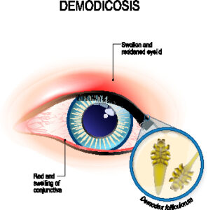 Treat Red Irritated Burning Eyelids | Blepharitis | Demodex | Mites