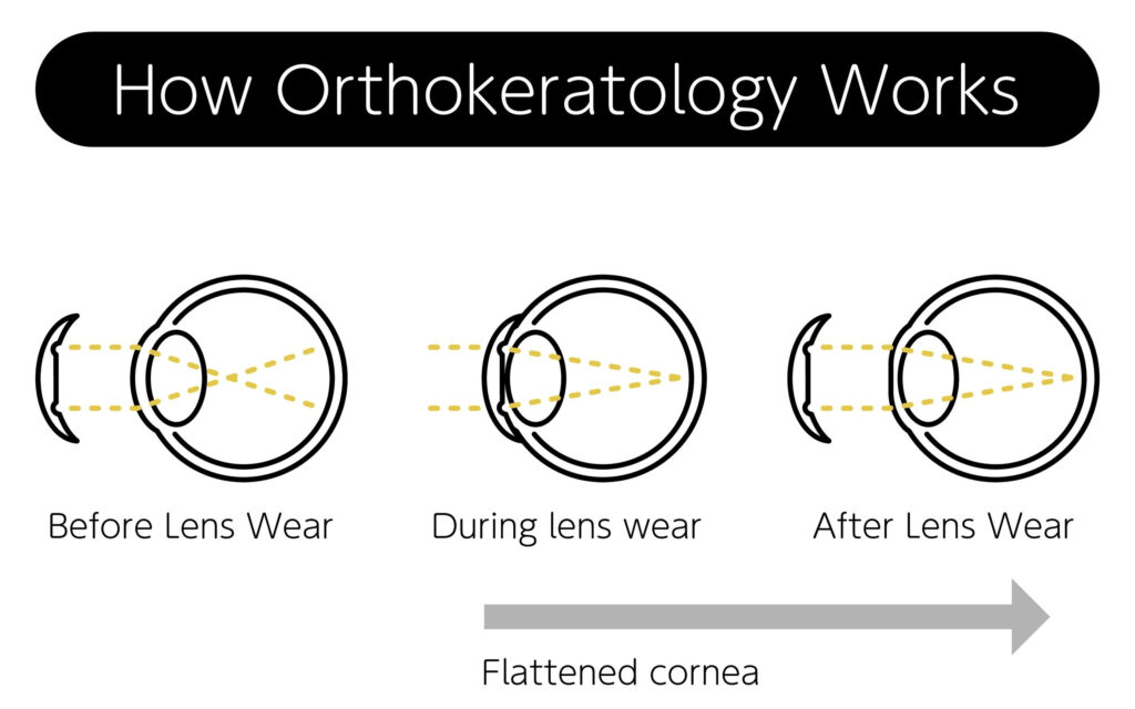 Diagram of how orthokeratology flattens the cornea overnight to focus light