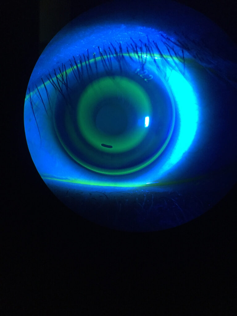 Scleral contact lens on the eye evaluated with fluorescein